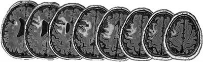 Extended Repetitive Transcranial Magnetic Stimulation Therapy for Post-stroke Depression in a Patient With a Pre-frontal Cortical Lesion: A Case Study